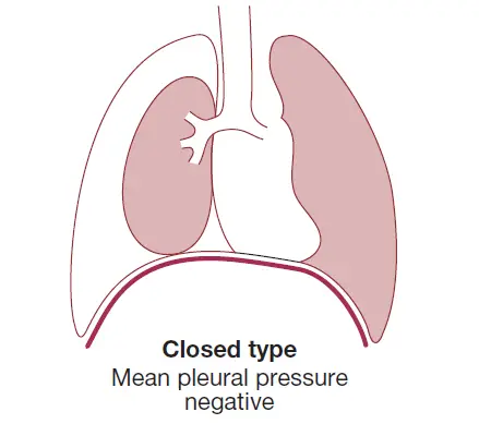 Tension Pneumothorax Explanation Causes Signs Symptoms And