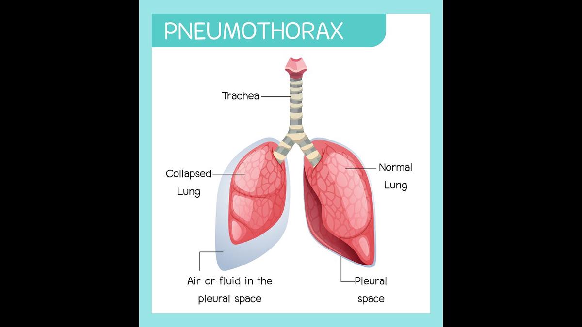 'Video thumbnail for Pneumothorax and Tension Pneumothorax | Explanation, Causes, Diagnosis, and Treatment'
