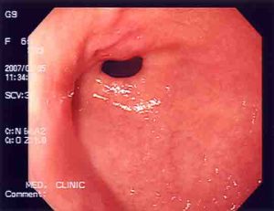 Erythematous mucosa in the antrum Endoscopy