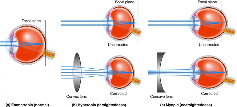 Myopia vs hypermetropia