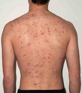 Chickenpox vs measles