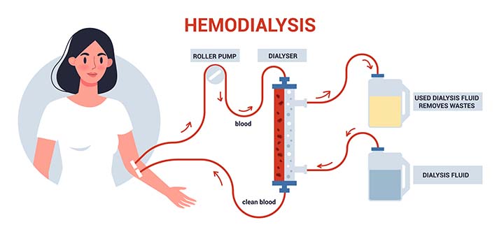 Hemodialysis due to renal infarction