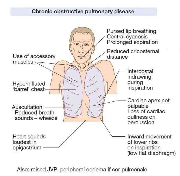 Pneumothorax Signs