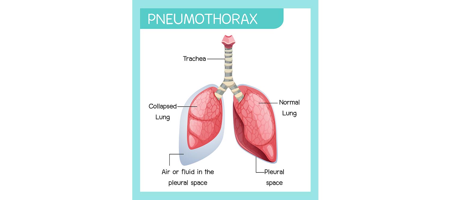 Tension Pneumothorax Explanation Causes Signs Symptoms And Treatment Learn From Doctor