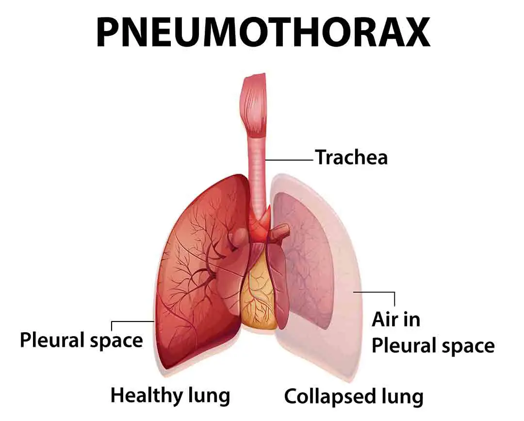 Pneumothorax Infographics