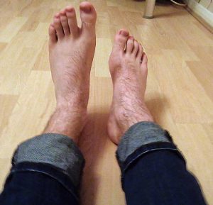 Foot Drop - Peroneal Nerve Injury