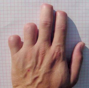 Index Finger Amputation