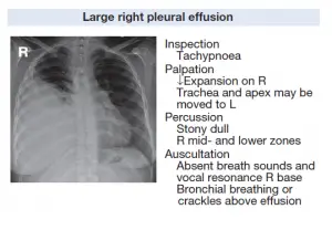 Large Right Pleural Effusion related with Tension Pneumothorax