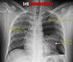 Tension Pneumothorax: Explanation, Causes, Signs, Symptoms, and ...