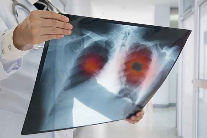 Radiological Study of Pulmonary Contusion