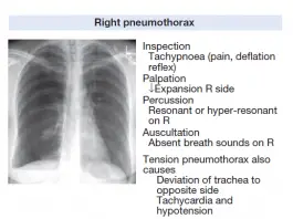 Tension Pneumothorax: Explanation, Causes, Signs, Symptoms, and ...