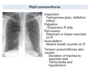 Right Tension Pneumothorax