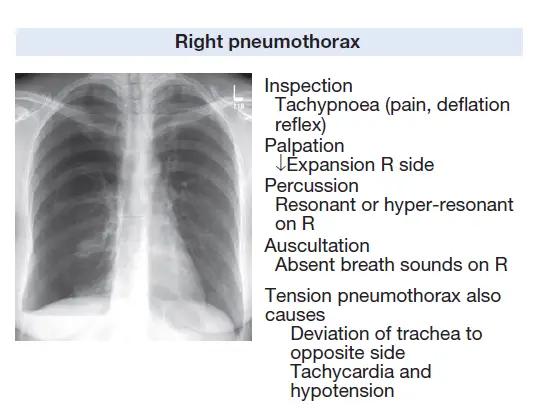 Tension Pneumothorax Signs And Symptoms