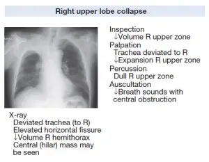 Right Upper Lobe Collapse related with Tension Pneumothorax