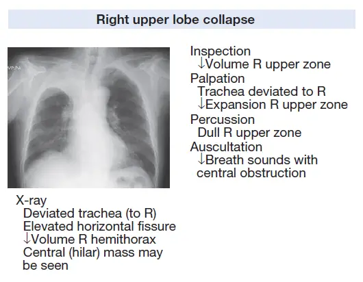 Pneumothorax Causes Signs Symptoms Treatment