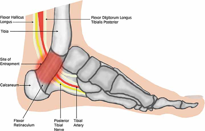 Tarsal Tunnel Syndrome due to Tibial Nerve Compression