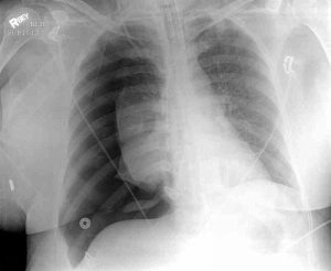 Tension Pneumothorax x-ray