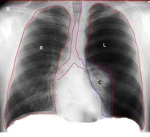 Tension Pneumothorax x-ray 2