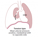 Tension Pneumothorax: Explanation, Causes, Signs, Symptoms, and ...