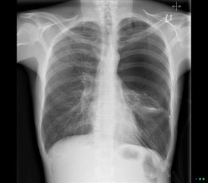 Congenital Lobar Emphysema Mistaken For Pneumothorax