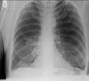 COPD Pulmonary Bullae