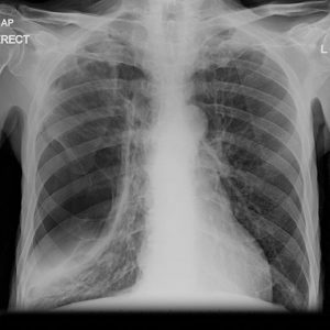 Loculated Pneumothorax x-ray film