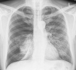 Pneumothorax x-ray sample radiograph