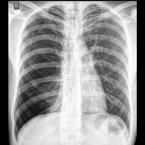 Pneumothorax x-ray sample study 2