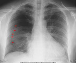 Pneumothorax on Inspiratory radiograph