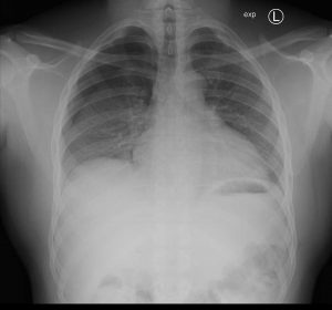 Pneumothorax on expiratory radiograph