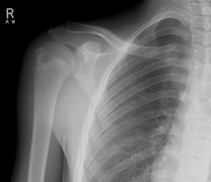 Pneumothorax on shoulder x-ray