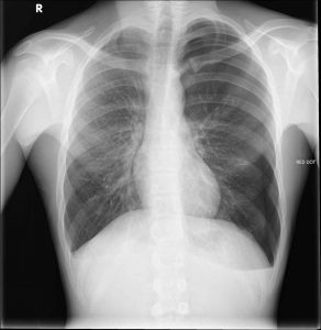 Pneumothorax Pediatric radiograph