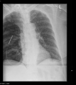 Pneumothorax Post malposition of nasogastric tube