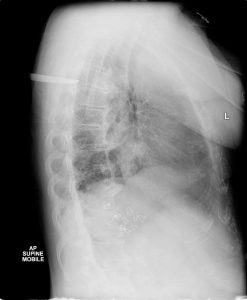 Traumatic Pneumothorax due to stabbing