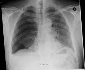Right-sided Pneumothorax due to rib fracture x-ray