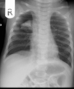 Spontaneous Pnumothorax-1 radiograph