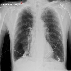 Spontaneous Pneumothorax 4 x-ray film