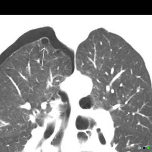 Spontaneous Pneumothorax due to ruptured apical bullae radiograph