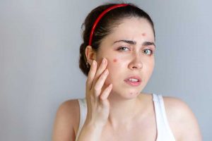Adolescence Syndrome is related to acne problem