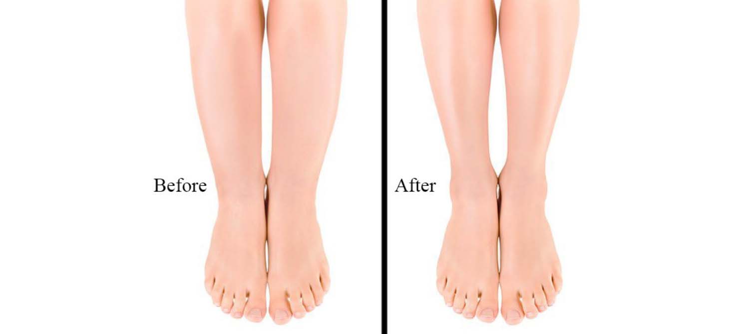 Cankles Before and After Cankle Liposuction