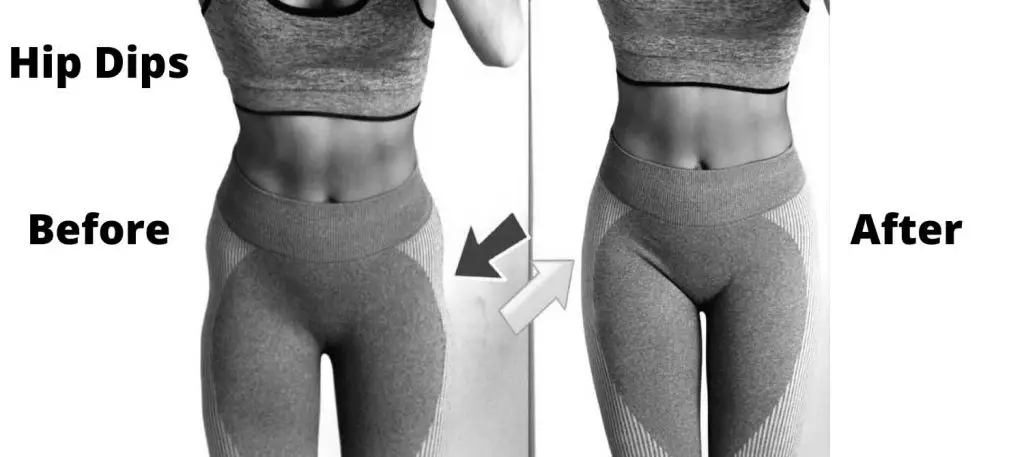 Hip Dips - Before and After
