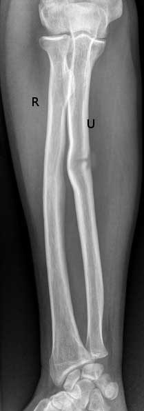 greenstick fracture in leg