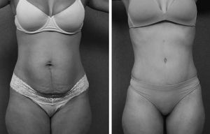 Body Sculpting before and after young female
