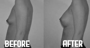 Fat Transfer Breast Augmentation before and after mid aged woman