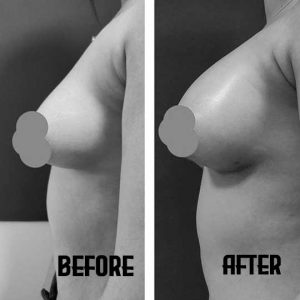 Fat Transfer Breast Augmentation before and after young female