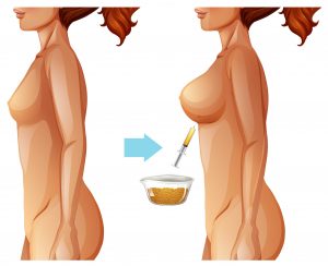 Breast augmentation fat transfer method illustration