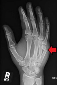 hand fracture x ray