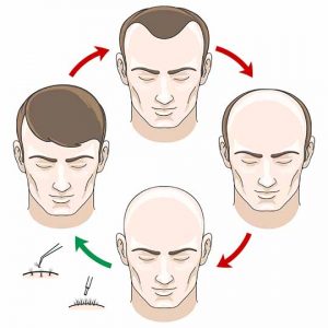 Basic method of hair transplantation