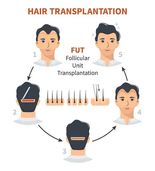 FUT - Follicular unit transplantation- the modern hair plugs