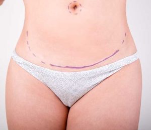 Fat transfer butt implant method